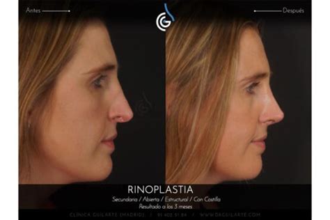 Rinoplastia Cirugía de la punta nasal operación de la nariz