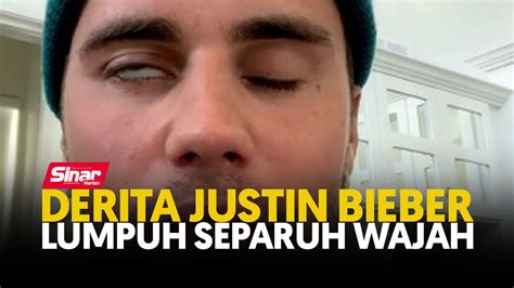 Derita Justin Bieber Lumpuh Separuh Wajah Video Dailymotion