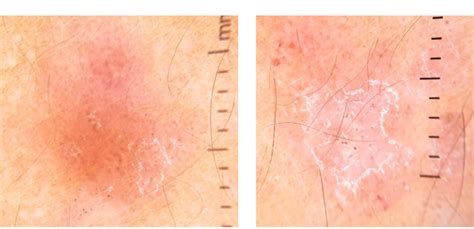 Dermatoscopia de lesiones placa con área eritematosa y descamación