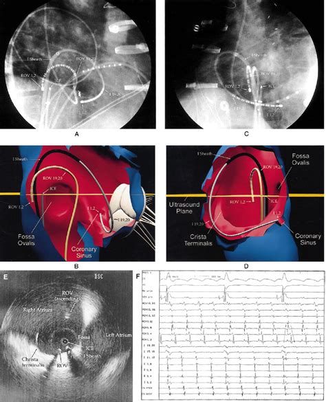 Figure From Global Right Atrial Mapping Of Human Atrial Flutter The