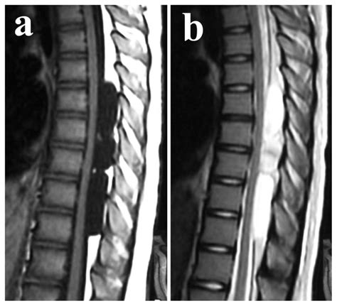 Spinal Arachnoid Cyst