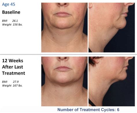 Reduce Double Chin Fat With Kybella New Orleans La