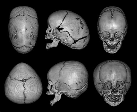 Sagittal Suture Synostosis Upper And Metopic Suture Synostosis