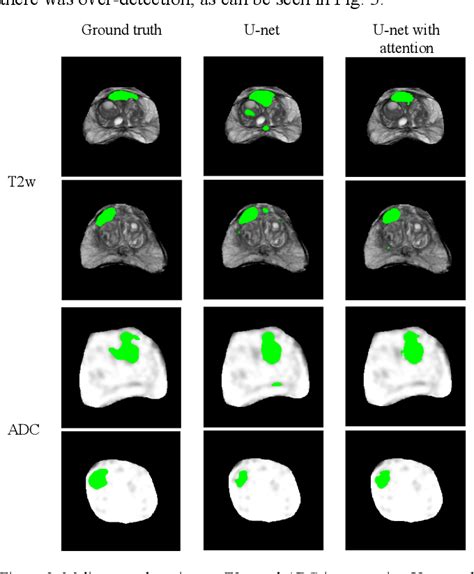 Figure 3 From Malignancy Detection In Prostate Multi Parametric Mr