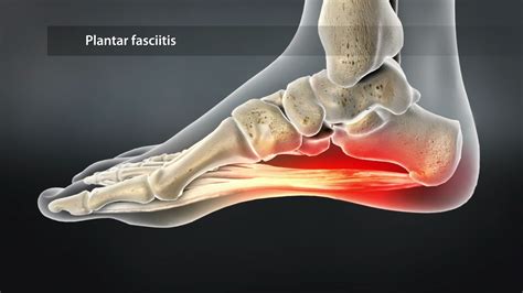 Plantar Fasciitis Research Update Saanich Physio Sports Clinic