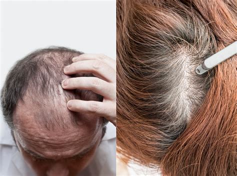 Does Testosterone Cause Hair Loss Revela