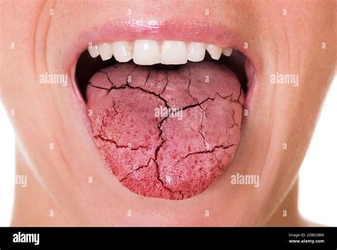 Candidiasis oral fotografías e imágenes de alta resolución Alamy