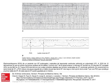 Electrocardiograma ECG De Un Paciente Con QT Prolongada Y Episodios