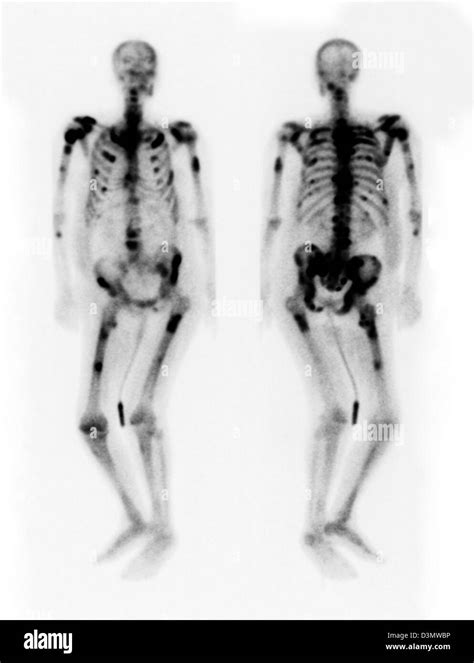 Bone Scan Showing Multiple Metastases Stock Photo 53934042 Alamy