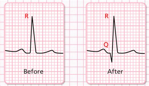 Pt 2 Acute Coronary Syndromes ACS Flashcards Quizlet