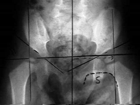 Radiographic Features Ddh Wheeless Textbook Of Orthopaedics