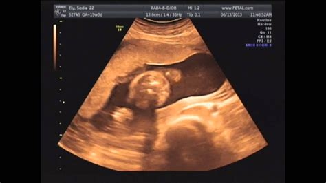 4d Ultrasound 2 Youtube