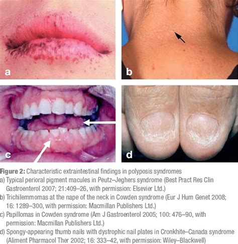 The Differential Diagnosis And Early Detection Of Hereditary