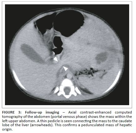 Hepatic Mesenchymal Hamartoma An Uncommon But Important Paediatric