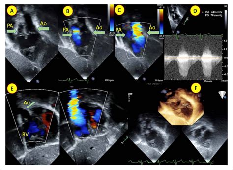 (A,B,C) Echocardiogram in subcostal oblique view and (E) subcostal ...