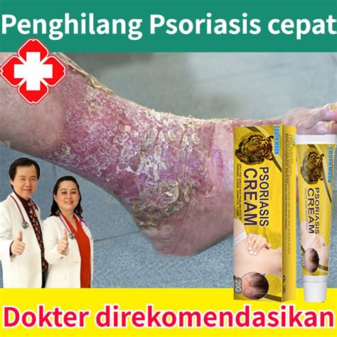 Jual Salep Gatal Salep Eksim Salep Kulit Krim Psoriasis Paling Ampuh