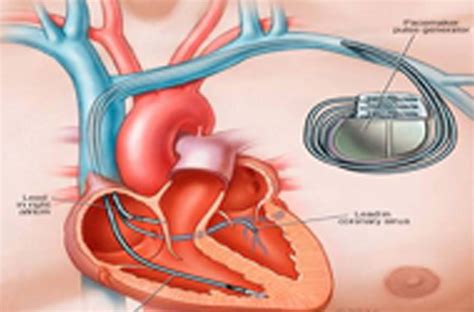 Biventricular Pacemaker