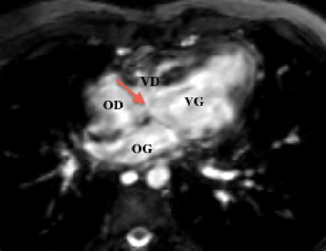 Canal Atrioventriculaire Imagerie Des Malformations Cardiaques