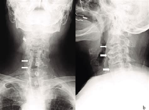 A Anteroposterior And B Lateral Radiographs Of Cervical Spine Show Download Scientific Diagram