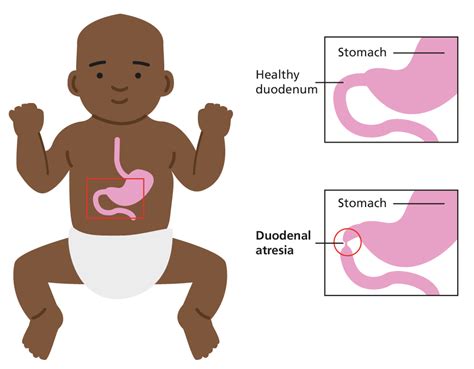 Antenatal Information About Duodenal Atresia Resource Library