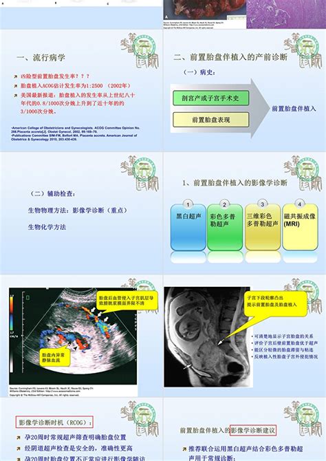 凶险型前置胎盘的诊治策略ppt卡卡办公