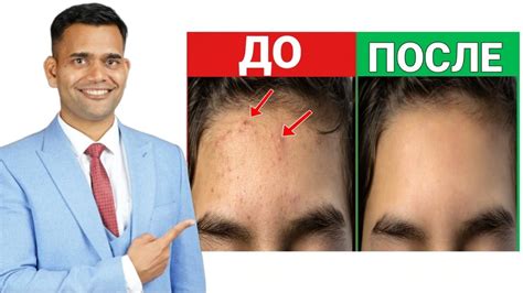 ПРЫЩИ НА ЛБУ? ЭТО ВАМ ПОМОЖЕТ! - YouTube