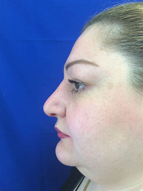 Rhinoplasty Specialist Downtown La Ca Los Angeles Center For Cosmetic