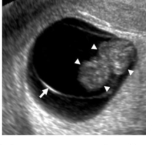 Figure 5 From A Logistic Model Of Early Pregnancy Ultrasound