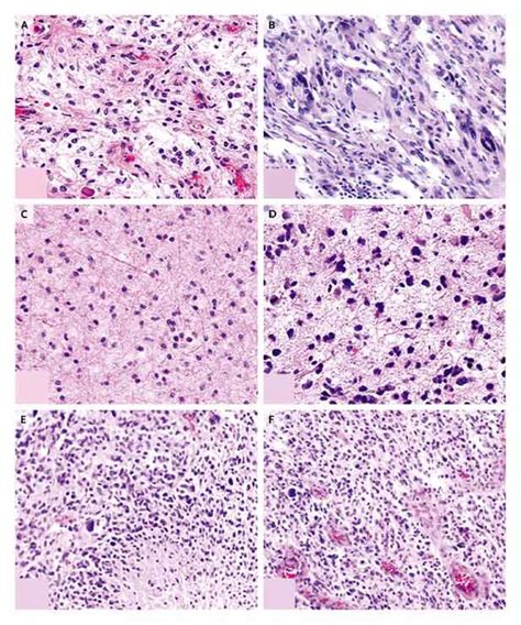 Grades of Glioma