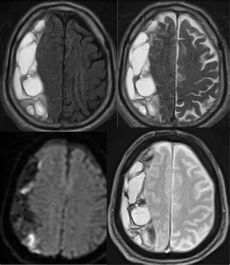 Acute On Chronic Subdural Hematoma