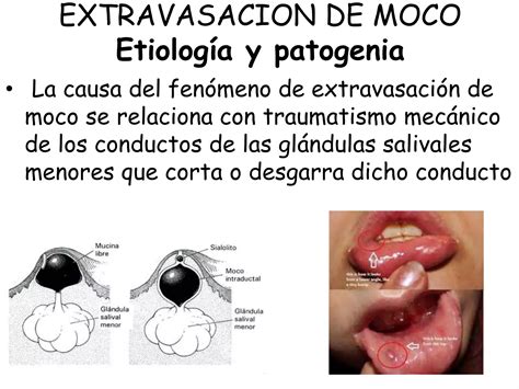 Patologias De Glandulas Salivales Ppt