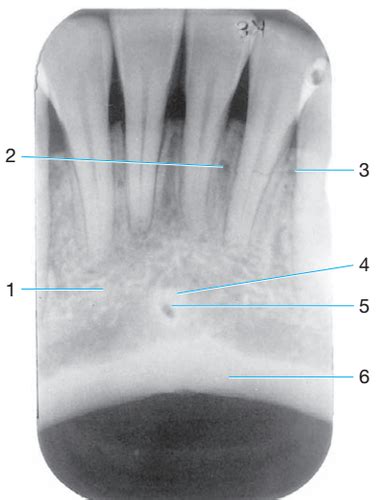 Lingual Foramen