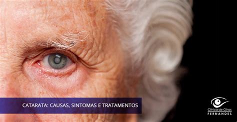 Catarata Causas Sintomas e Tratamento Clínica de Olhos Fernandes