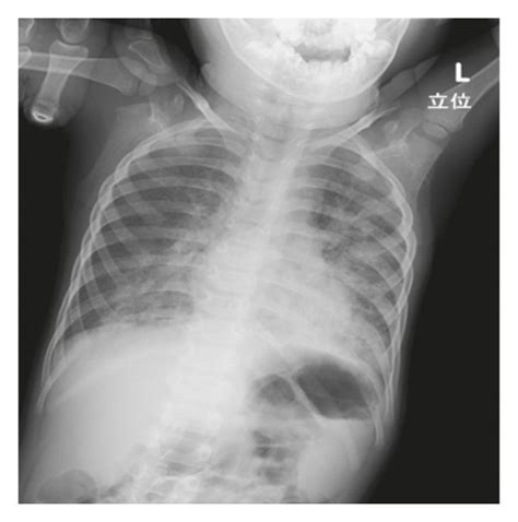 A Posteroanterior Chest Radiography Demonstrating Bilateral Pulmonary