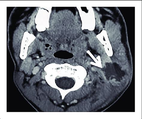 Tuberculous Sialadenitis Axial Contrast Computed Tomography CT Scan