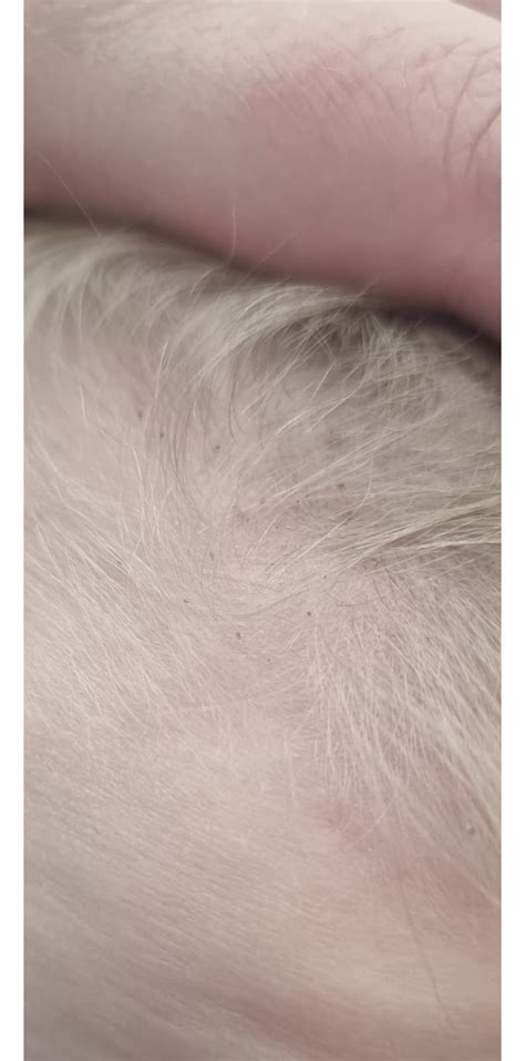 Weird Scabs Rskin