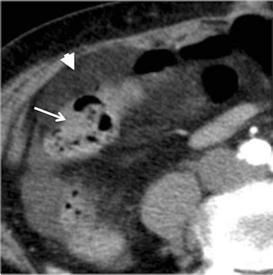 Omental Infarction Axial Contrast Enhanced CT Scan Of A Patient Who