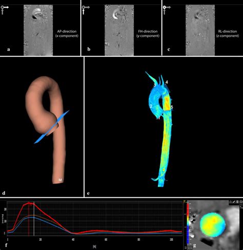 A Clinicians Guide To Understanding Aortic D Flow Mri Pmc