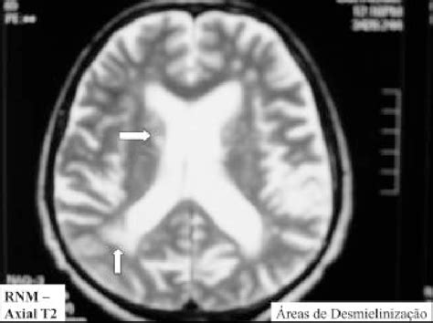 Axial T2 MRI section showing areas of demyelination. | Download ...