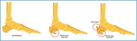 calcaneal osteotomy heel bone spur yellowstone surgery center