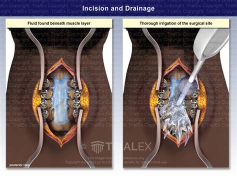 Incision And Drainage Trial Exhibits Inc