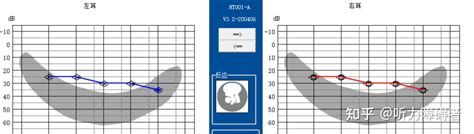 重庆渝北加州惠耳听力助听器：高频陡降型的助听器选配 知乎