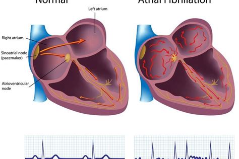 Migotanie przedsionków przyczyny objawy leczenie ekg