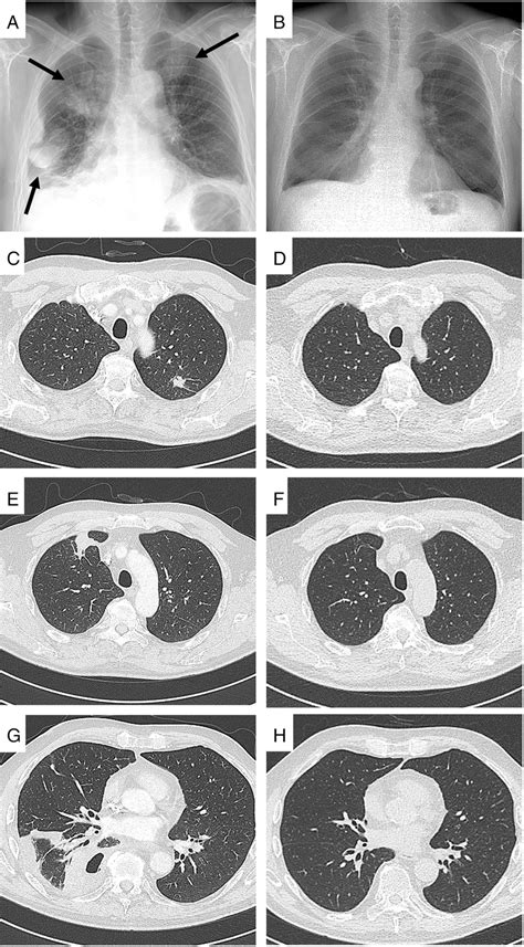 Chest X‐ray A And Computed Tomography Ct Scan C E G At