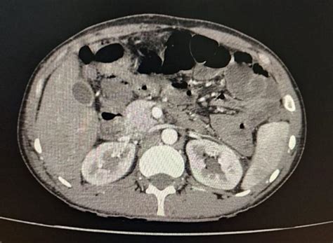 Angiotomografia Tac Abdomen Mediolisis Arterial Segmentaria Ocronos