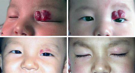 Figure 1 From Management Of Periorbital Hemangioma By Intralesional