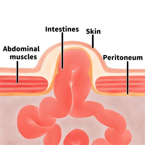 10 Umbilical Hernia Surgery Stock Illustrations Royalty Free Vector