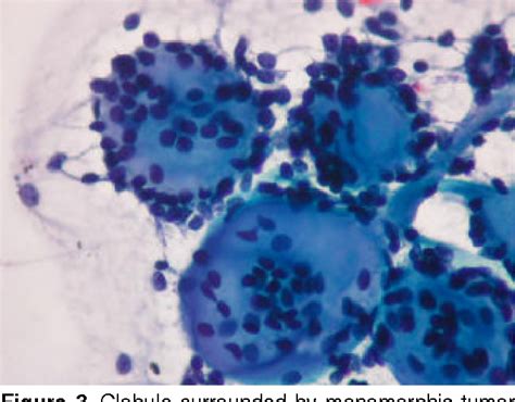 Figure 3 From Fine Needle Aspiration Cytology Of The Salivary Glands A