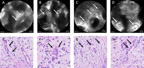 Endomicroscopic Features Of Signet Ring Cell Carcinoma With