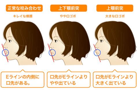 口ゴボ（くちごぼ）の治し方 明石市の歯医者 明石アップル歯科